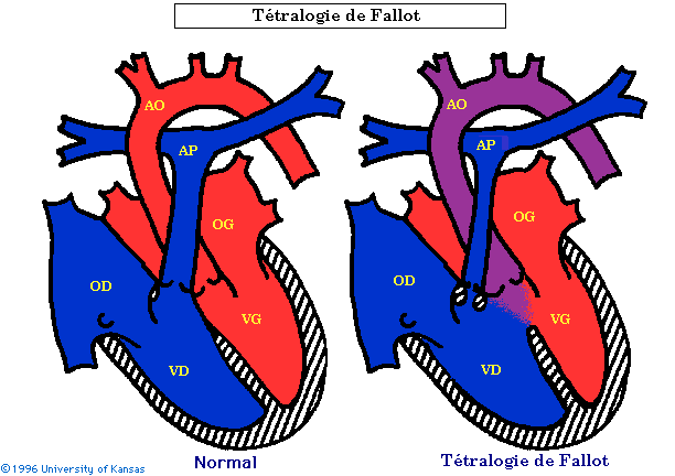 ttralogie de Fallot
